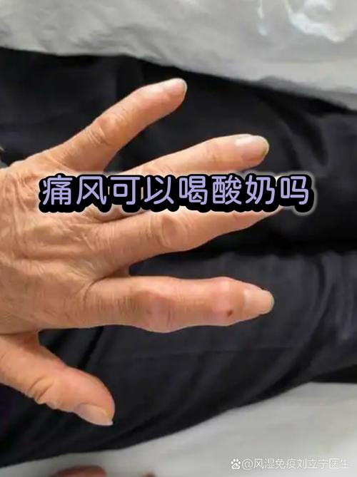 痛风发作屁股会痛吗