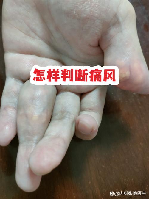 痛风发作屁股会痛吗