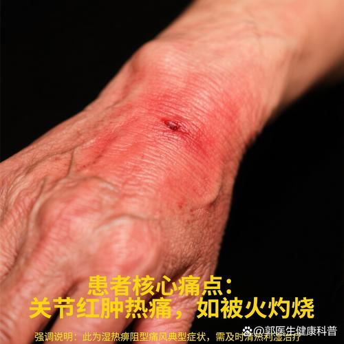 中国蜂疗怎么治痛风