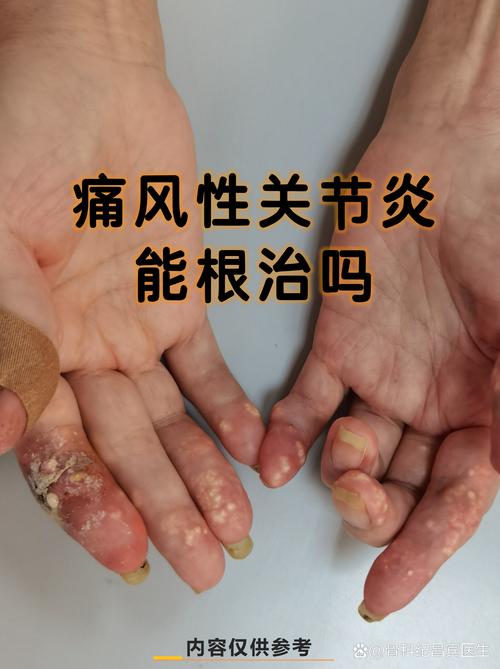 花青素能治疗痛风吗