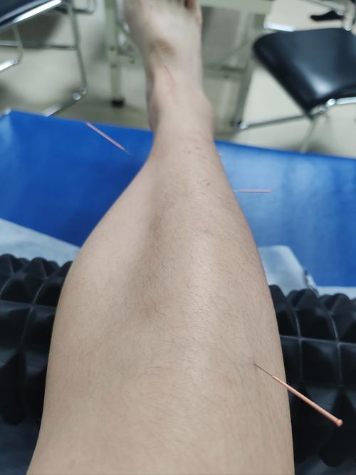 针灸以后腿酸软无力