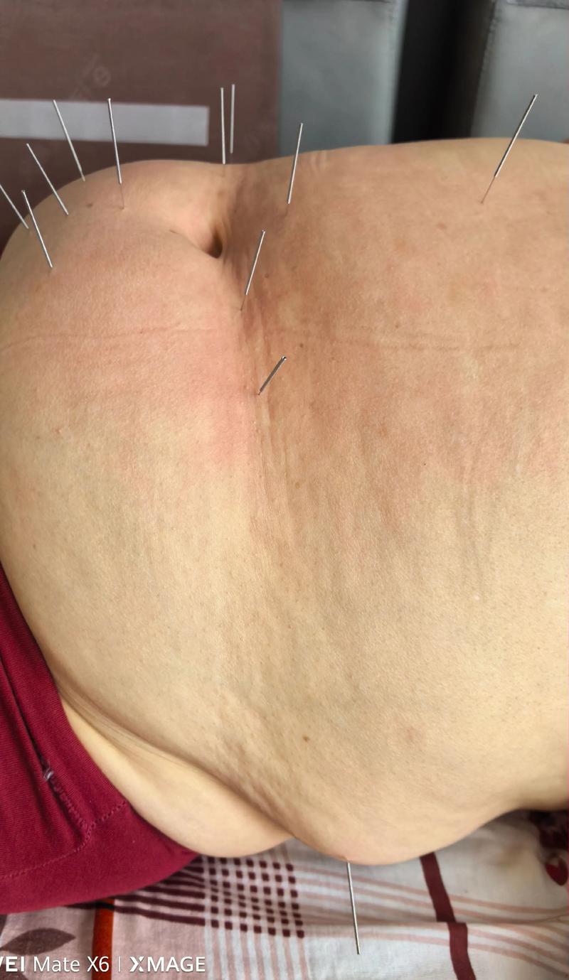 宜昌中医院针灸减肥