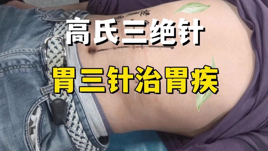 腹胀胃胀针灸扎哪儿