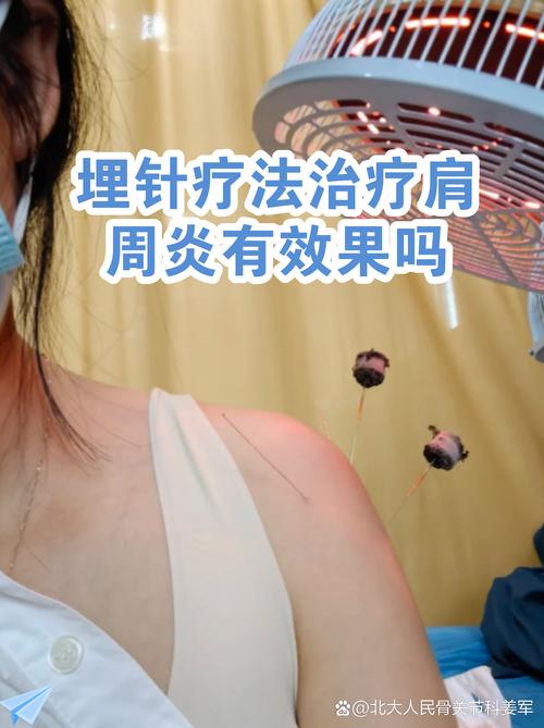 肩部针灸后能染发吗