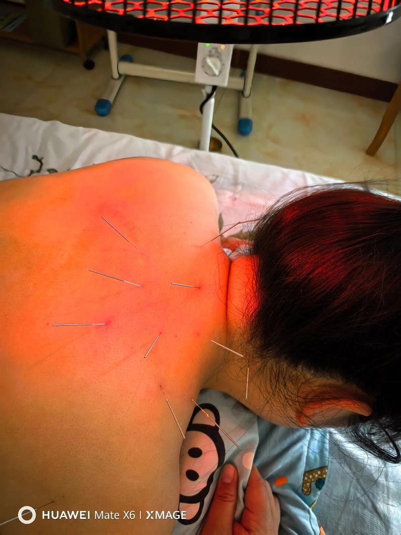 肩部针灸后能染发吗