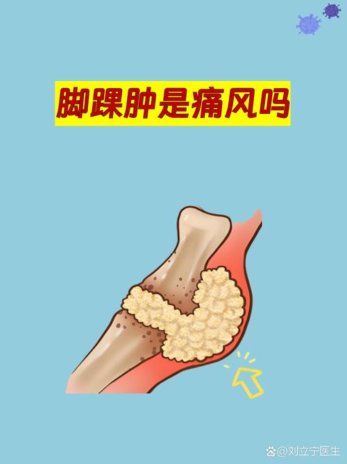 脚脖子筋疼是痛风吗