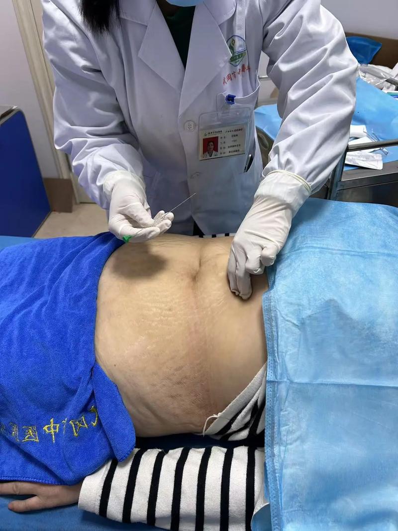 西安中医院针灸减肥