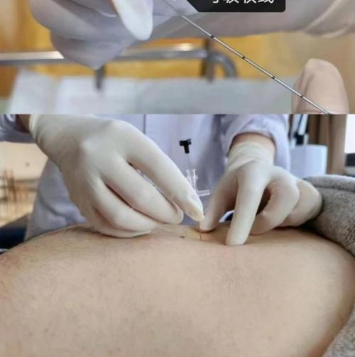 西安中医院针灸减肥