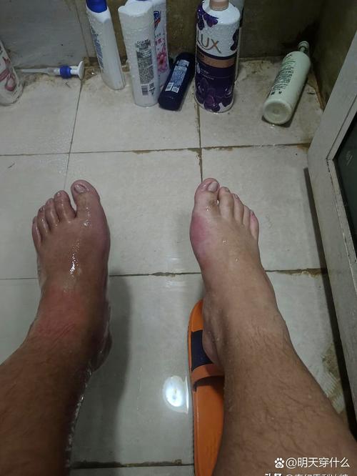 打篮球会痛风发作吗