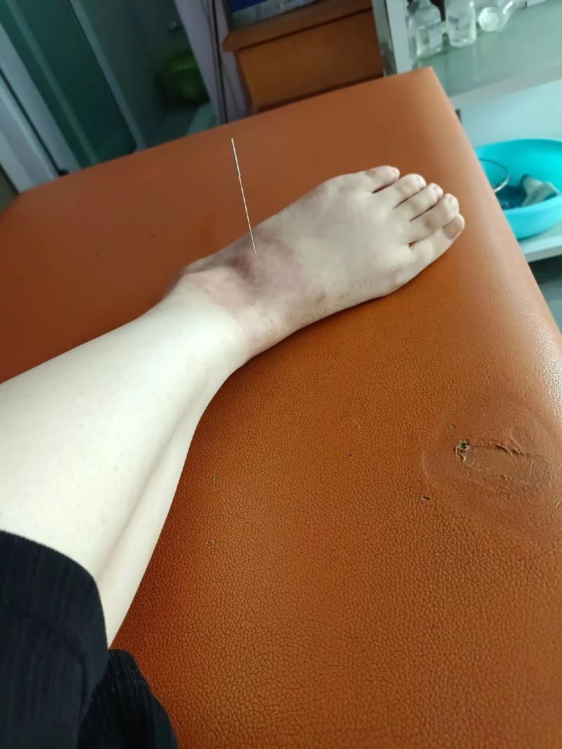 脚痛风肿痛做电针灸