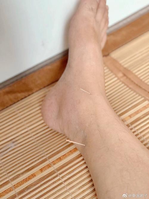 脚痛风肿痛做电针灸