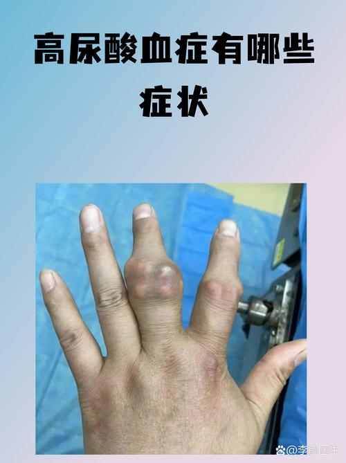 痛风一般几天能走路