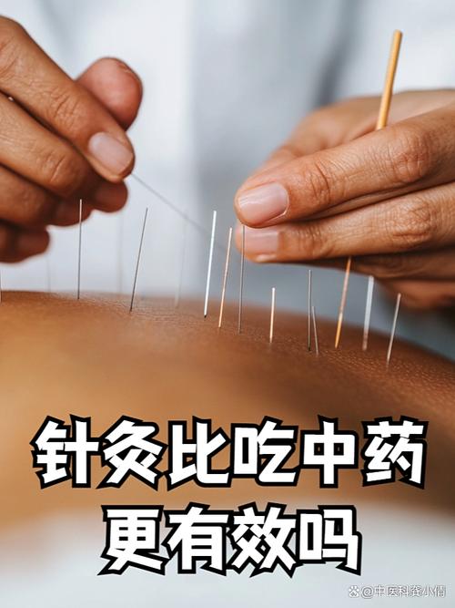 针灸可以打通经络吗