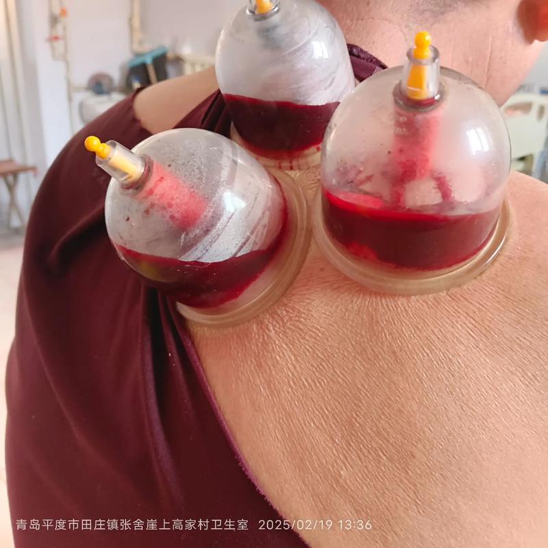 针灸后马上拔罐好吗