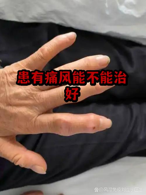 国康医院能治痛风吗