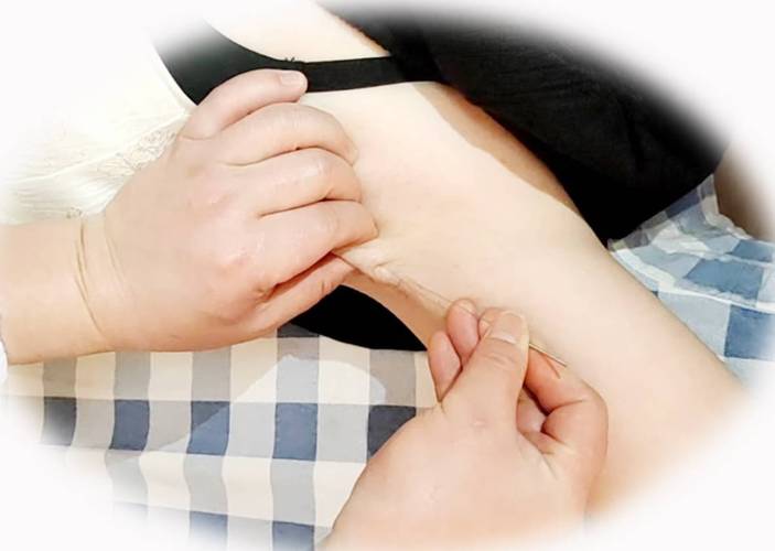 狐臭中医针灸可以吗