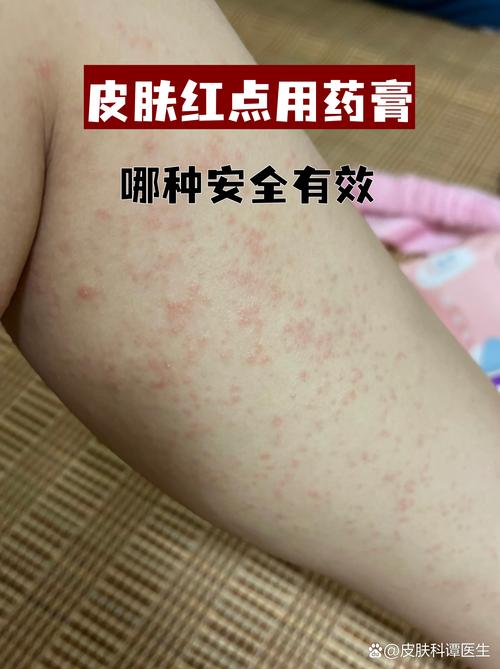 痛风可以涂红花油吗