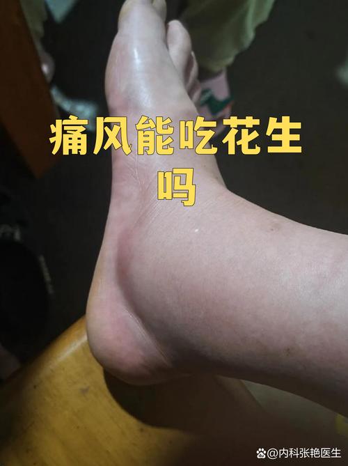 江苏省中医院 痛风