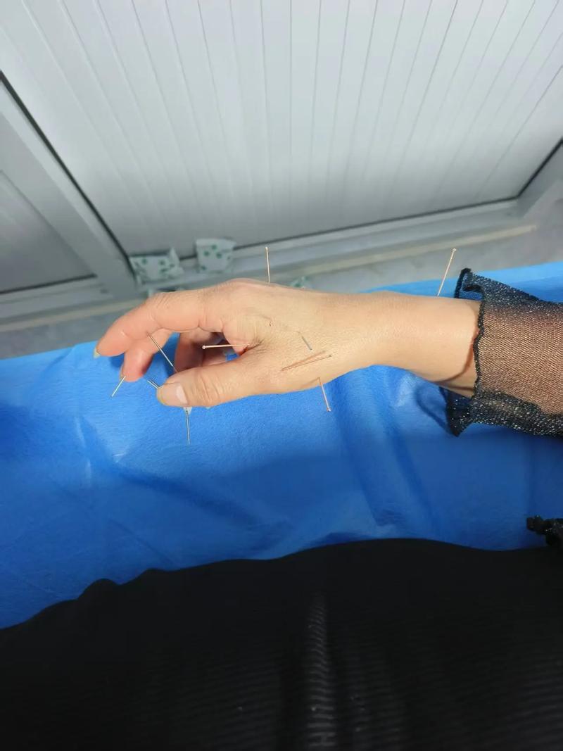 尺神经麻痹针灸治疗