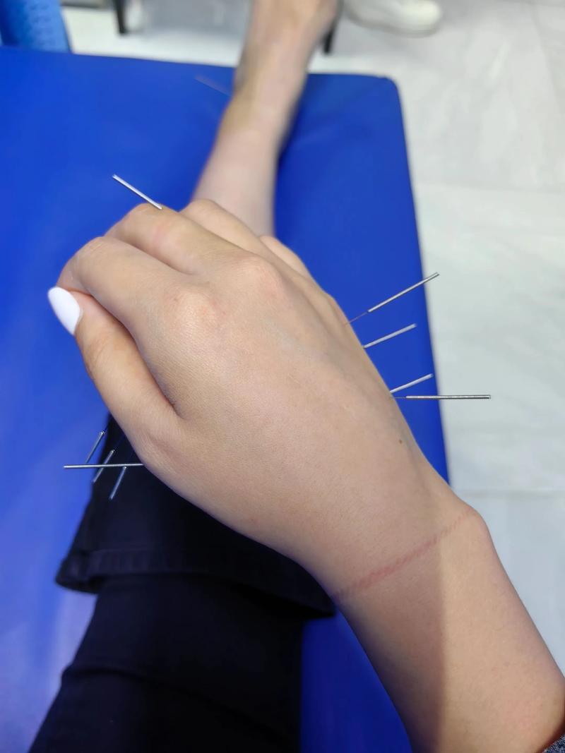 尺神经麻痹针灸治疗