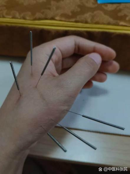 针灸可以治疗胃炎吗