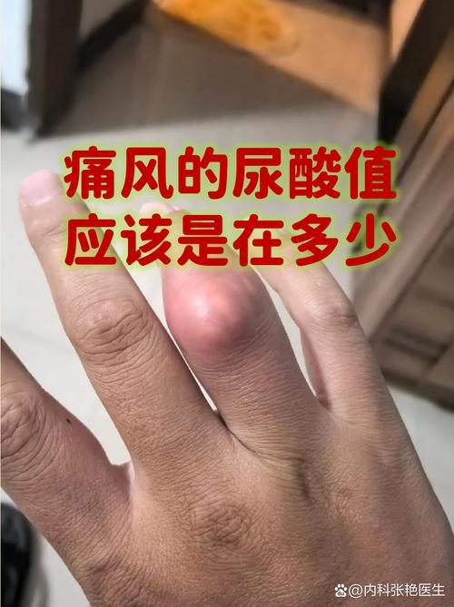 尿酸高就一定痛风吗