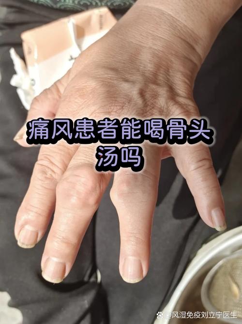 痛风病人喝什么汤好