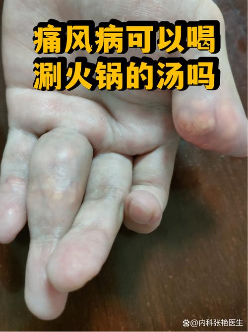 痛风病人喝什么汤好