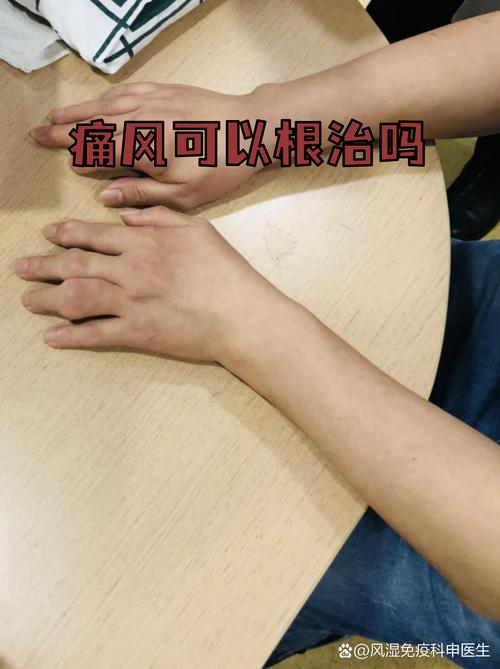 胳膊疼会不会是痛风