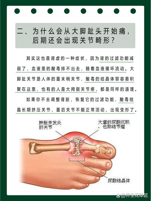 痛风尿酸一定会高吗