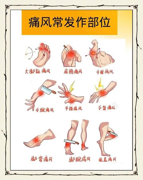 痛风全身肿了怎么办