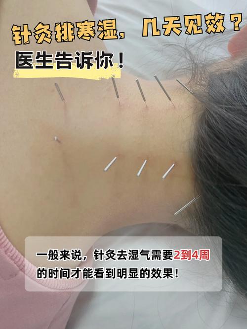针灸最多可以扎几天