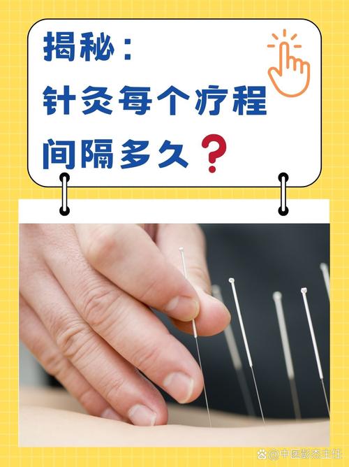 针灸最多可以扎几天