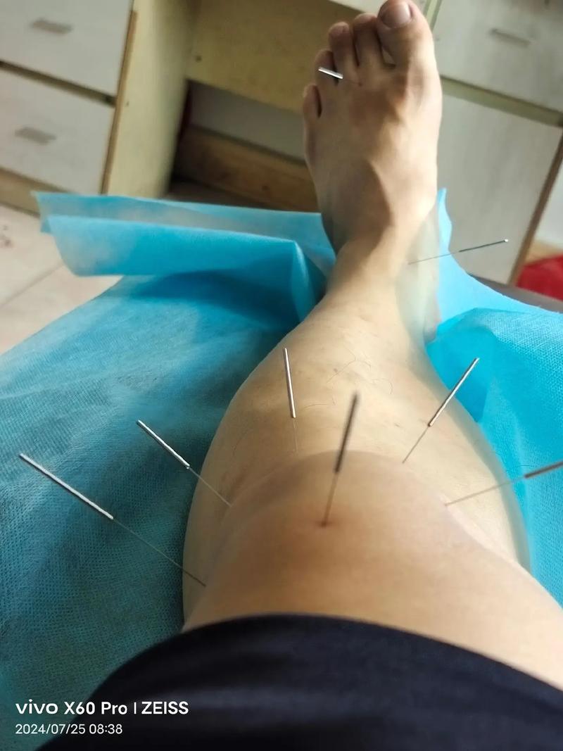 左腿针灸完之后疼痛