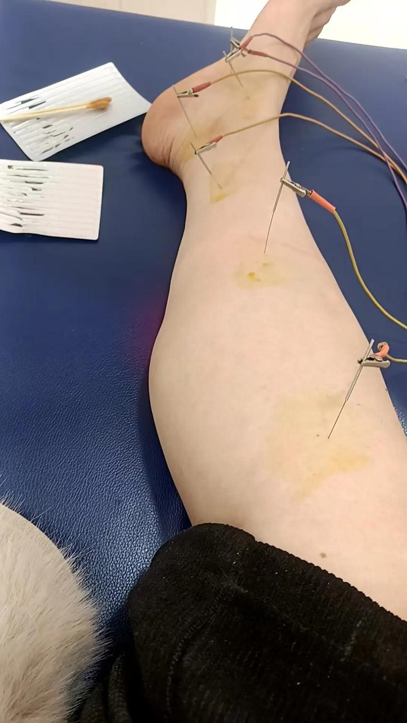 左腿针灸完之后疼痛