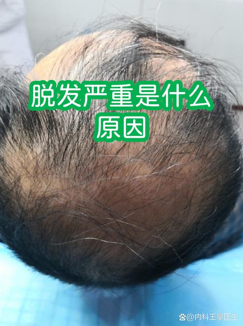 哈尔滨脱发医学会安全