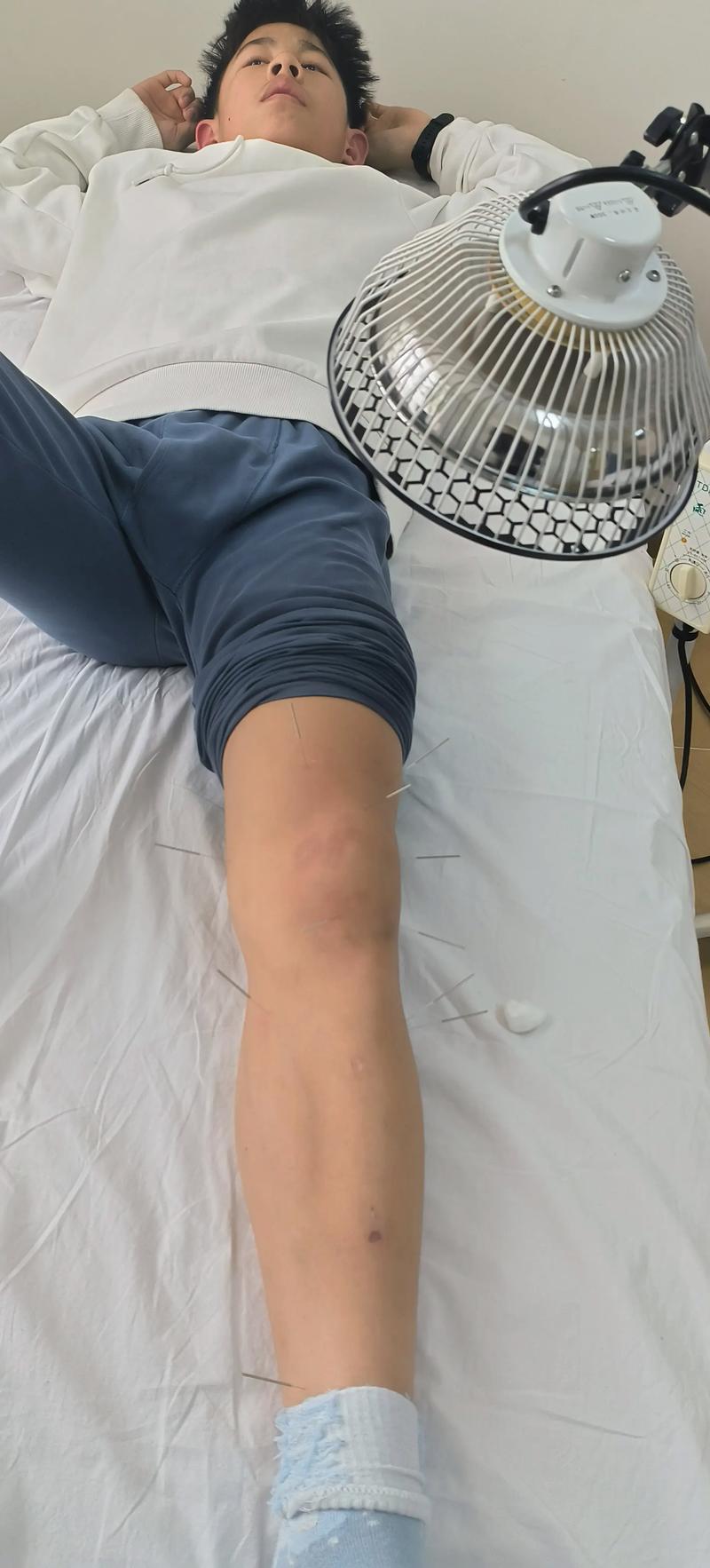 关节积液可以针灸吗