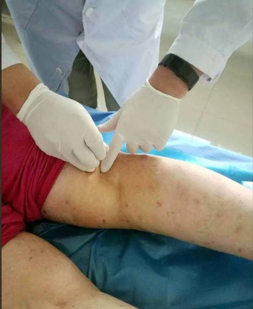 关节积液可以针灸吗