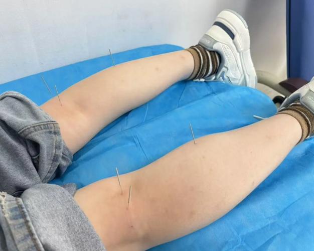 关节积液可以针灸吗