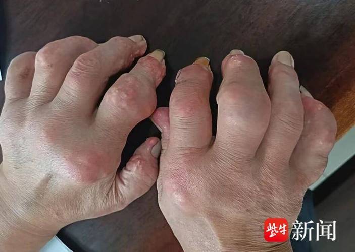 痛风石摸起来痛不痛