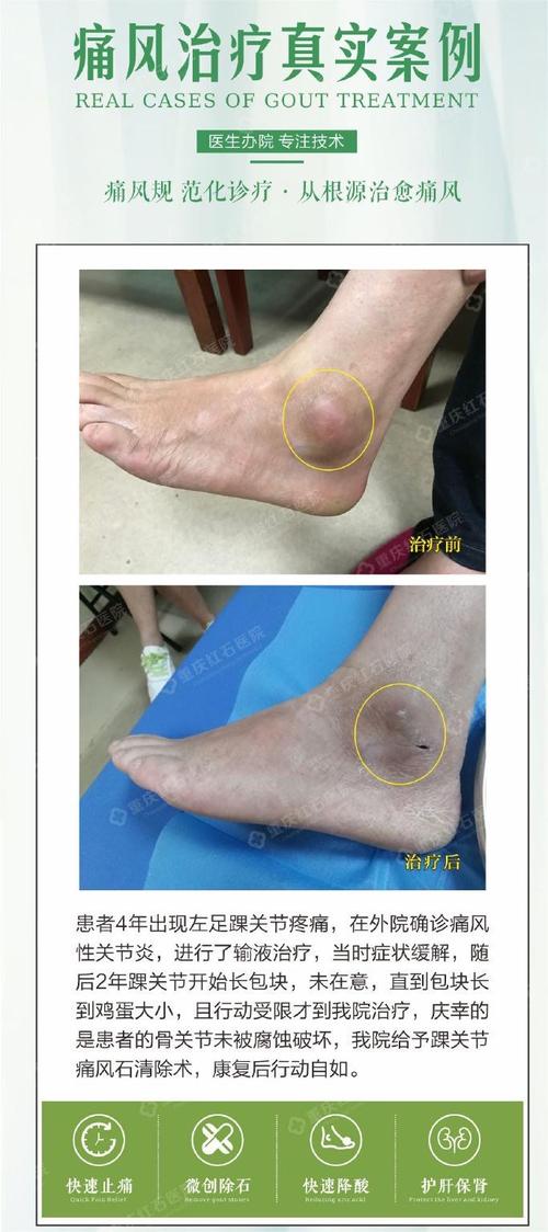 痛风石摸起来痛不痛