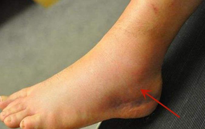 脚踝关节痛风的症状