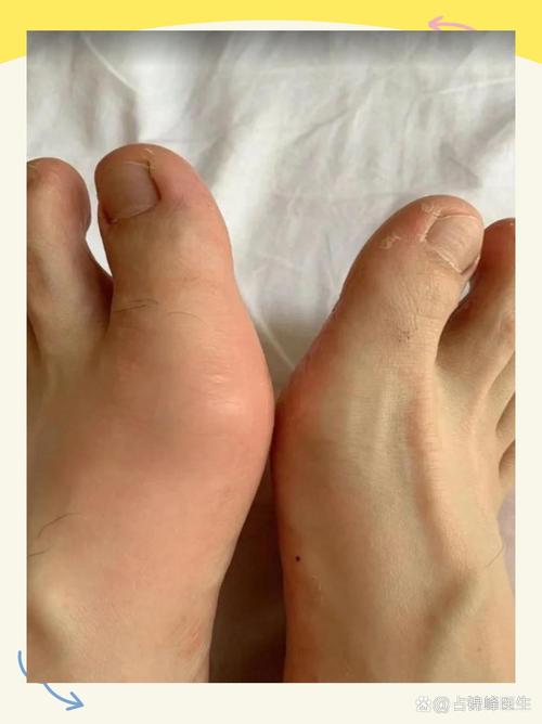 脚踝关节痛风的症状