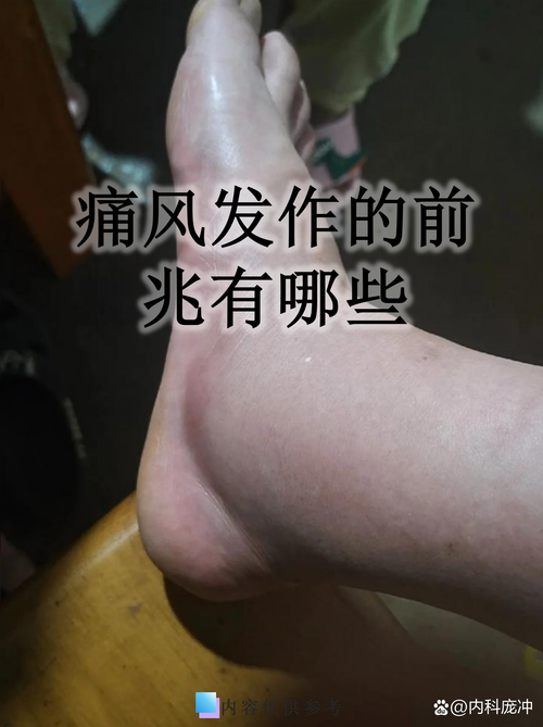 脚踝关节痛风的症状