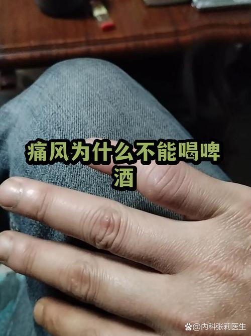 痛风喝啤酒后怎么办