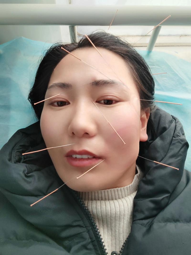 中枢性面瘫针灸治疗