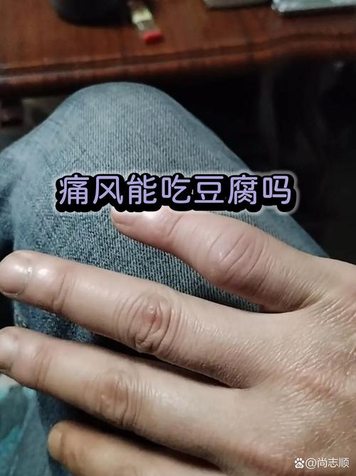 痛风可以吃碳酸钙吗