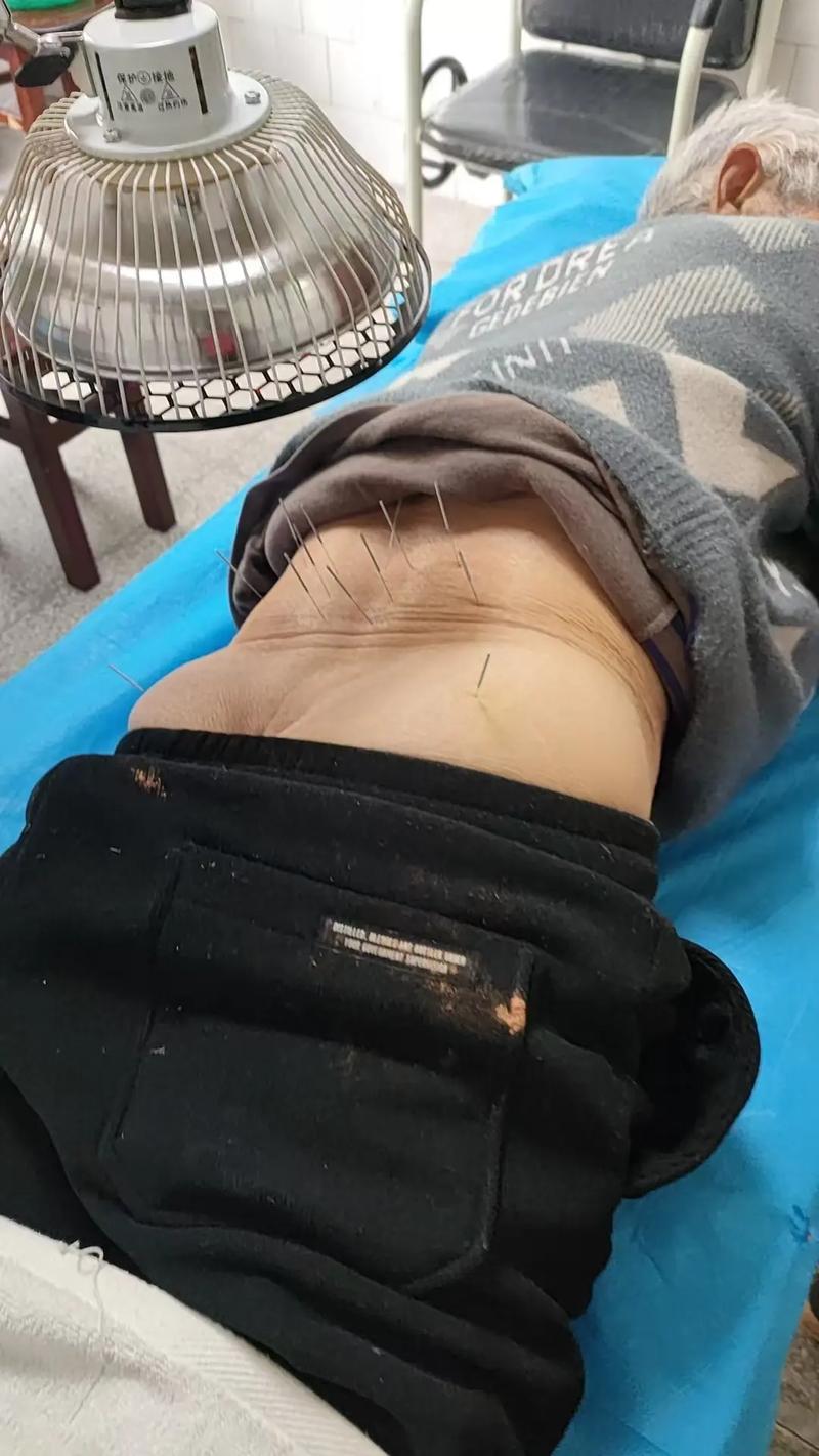 腰肌劳损做针灸好吗