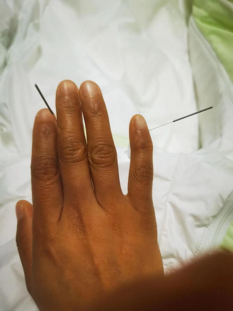 关节痛 针灸 艾灸