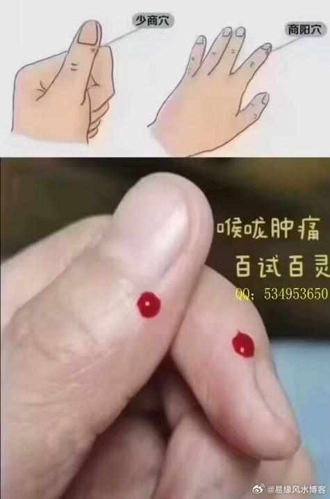 针灸可以治疗口吃吗